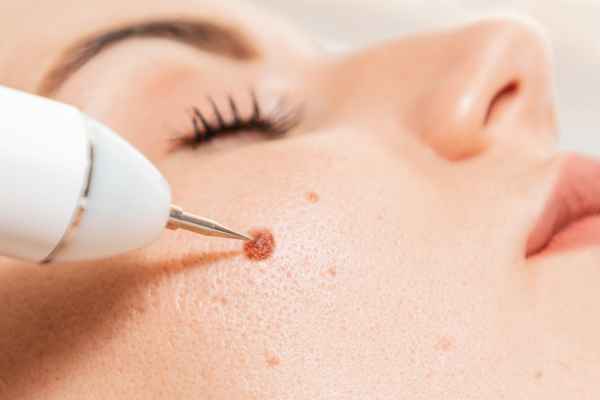 CryoPen: 5 Skin Concerns It May Be Used to Treat 3 What actually happens during a CryoPen treatment Swinton?