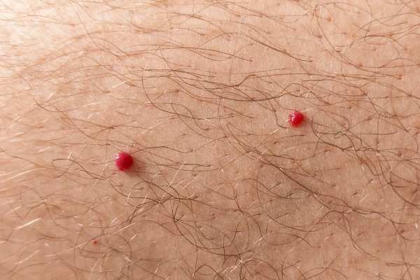 CryoPen: 5 Skin Concerns It May Be Used to Treat 2 cherry angioma removal Swinton
