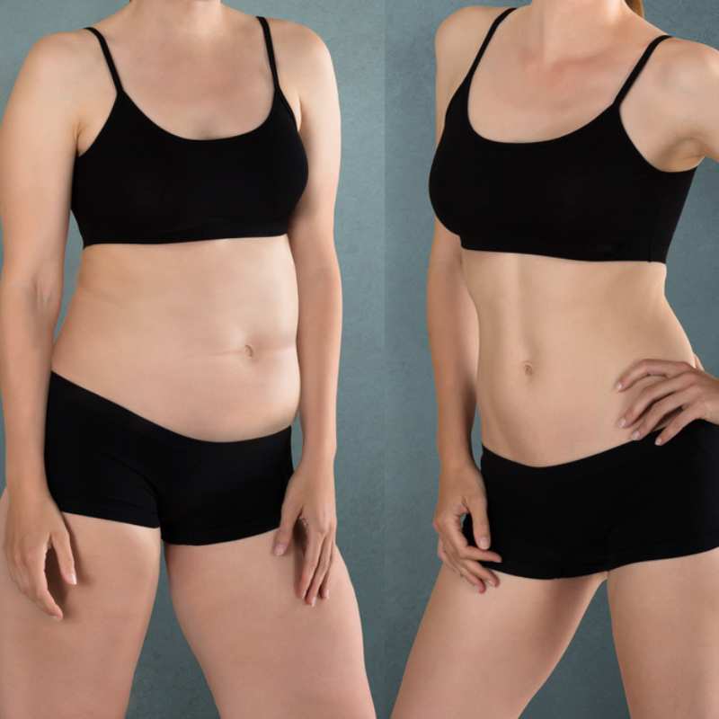 Does Fat Freezing at Home Work? DIY Devices vs Professional Cryolipolysis 2 before and after Cryolipolysis Swinton