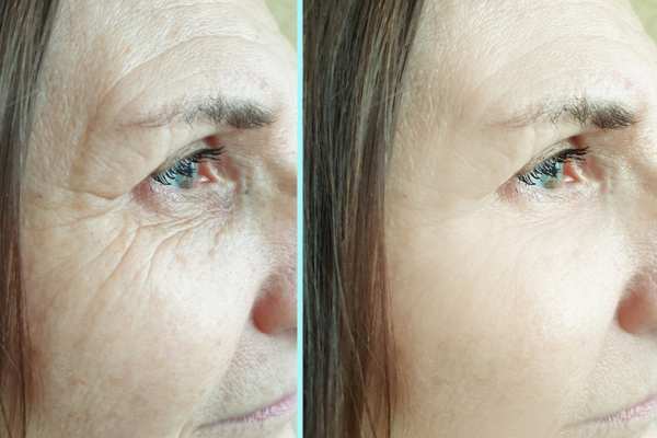 Why Do People Choose HIFU for a Non-Surgical Facelift? 4 How long can HIFU results last Swinton?