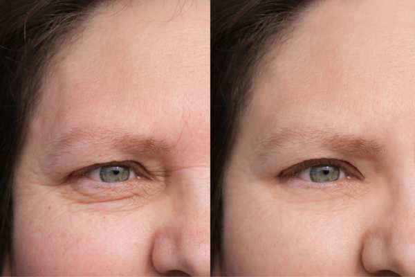HIFU vs Botulinum Toxin: Understanding the Differences 4 How long do HIFU results last Swinton?