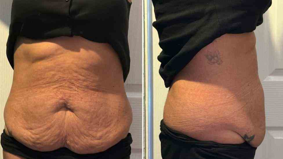 Lost the Weight but Not the Loose Skin? What You Should Know 1 Is It Definitely Loose Skin Swinton?